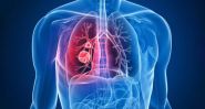 Cancer du poumon: au Liban, le souffle court de la prévention
