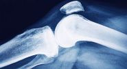 Osteoporosis: The Other Silent Burden