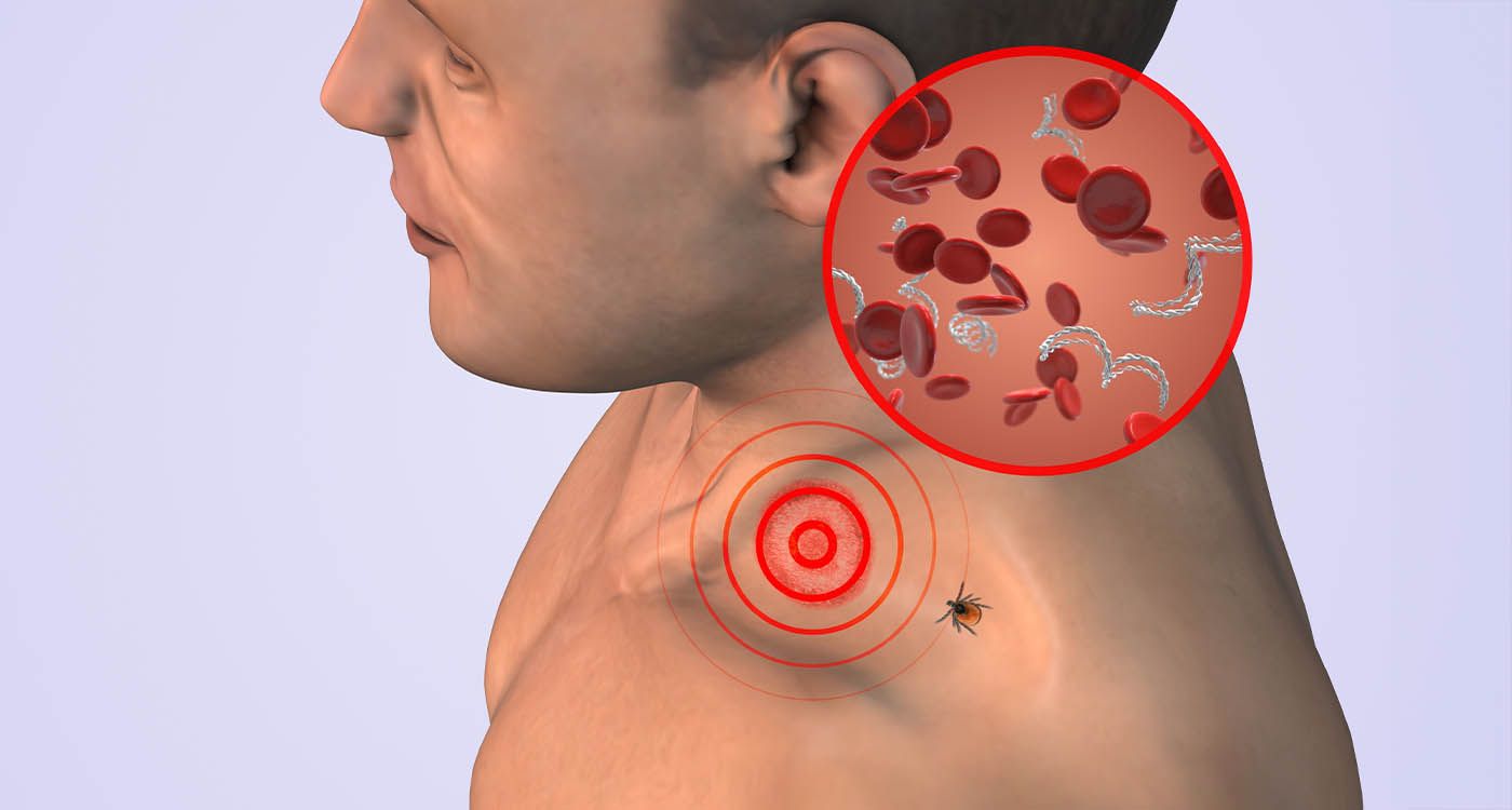 Maladie de Lyme: la bactérie qui sait se rendre invisible 
