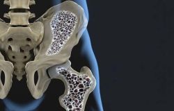 Ostéoporose: au Liban, ne pas attendre la fracture