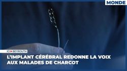 L'implant cérébral redonne la voix aux malades de Charcot