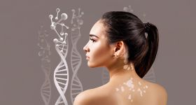 Vitiligo au Liban: entre tabous et parcours de soins