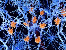 Sclérose en plaques: au Liban, le diagnostic n’est que le début du parcours