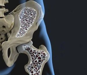 Ostéoporose: au Liban, ne pas attendre la fracture