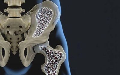 Ostéoporose: au Liban, ne pas attendre la fracture