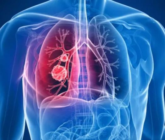 Cancer du poumon: au Liban, le souffle court de la prévention