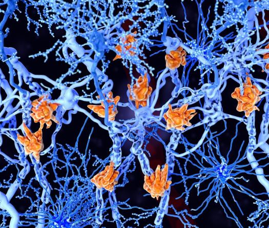 Sclérose en plaques: au Liban, le diagnostic n’est que le début du parcours