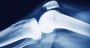 Osteoporosis: The Other Silent Burden