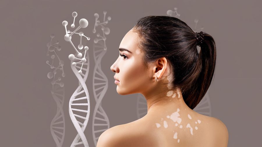 Vitiligo au Liban: entre tabous et parcours de soins