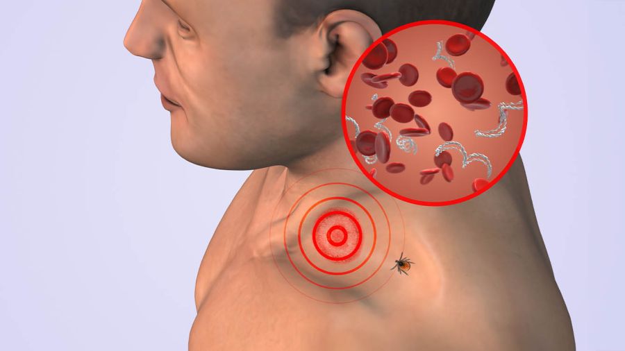 Maladie de Lyme: la bactérie qui sait se rendre invisible 