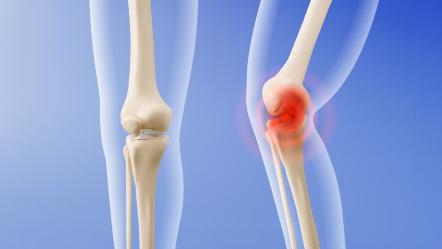 Cartilage intelligent, la nouvelle frontière contre l’arthrite?